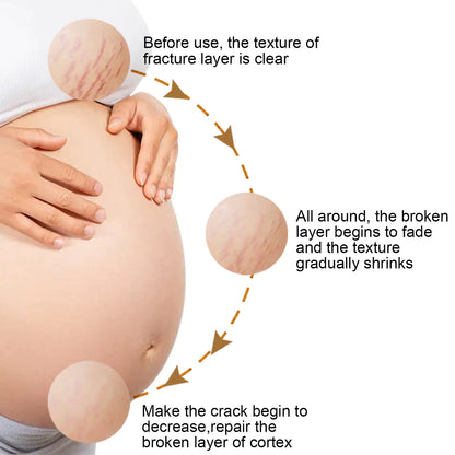 EELHOE Skin Care Cream for Pregnancy and Scars